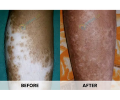 Effective Vitiligo Treatment in Delhi : Revitalize Your Skin