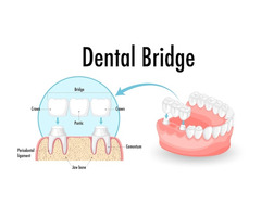 Crowns And Bridges In Dwarka