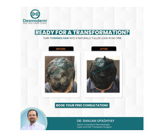 Effective Hair Transplant In Delhi At Desmoderm