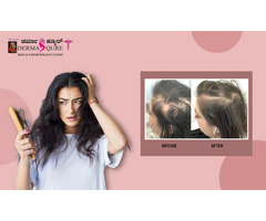 Best Hair Loss Treatment in Bangalore by Dermaqure