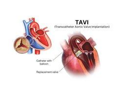 DrRavindrasingrao - Best Cardiologist in India for TAVI Surgery