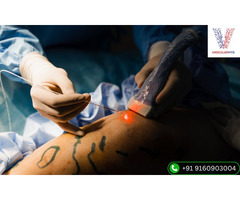 Varicose Veins Laser Treatment in Hyderabad | Vascularhyd