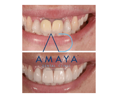 Best dental clinic in Bangalore | Amaya