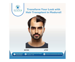 Best Hair Transplant in Madurai | Renew Hair & Skin Care